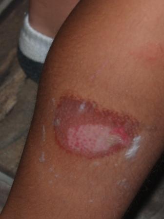 LukeyLegBurn
